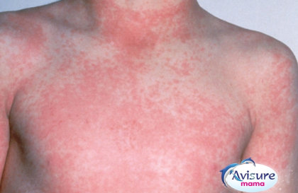 Tìm hiểu về bệnh ban đỏ ở trẻ em